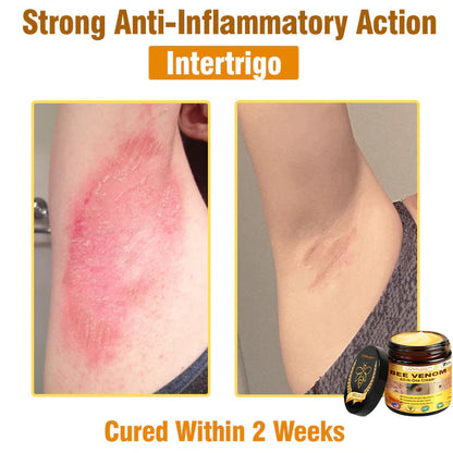 𝐋𝐎𝐕𝐈𝐋𝐃𝐒™ 𝐁𝐞𝐞 𝐕𝐞𝐧𝐨𝐦 𝐀𝐥𝐥-𝐢𝐧-𝐎𝐧𝐞 𝐂𝐫𝐞𝐚𝐦–🌸 Anti-aging,Hydrating, Skin Repair, Even Tone, Acne and Dark Spot Treatment, Wart and Mole Removal, Psoriasis Relief