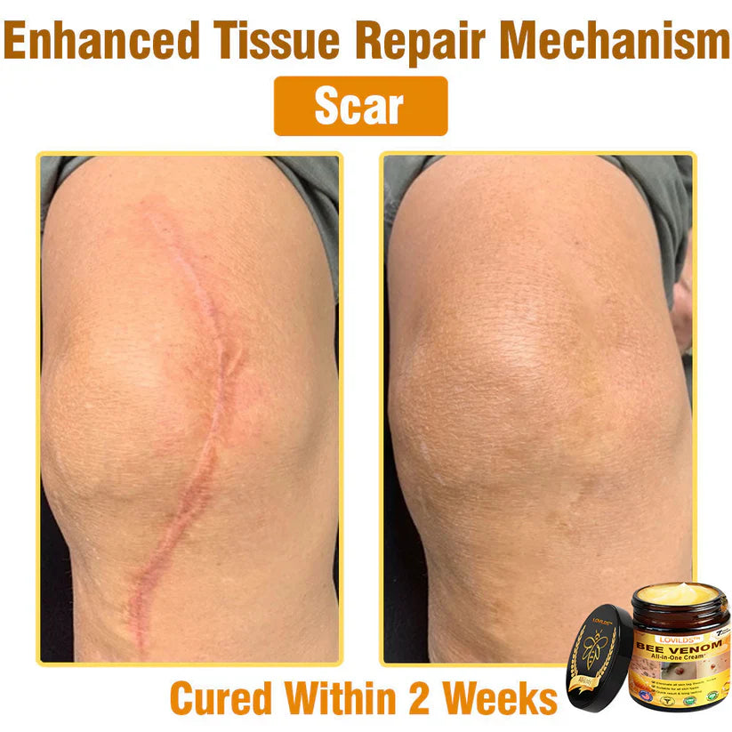 𝐋𝐎𝐕𝐈𝐋𝐃𝐒™ 𝐁𝐞𝐞 𝐕𝐞𝐧𝐨𝐦 𝐀𝐥𝐥-𝐢𝐧-𝐎𝐧𝐞 𝐂𝐫𝐞𝐚𝐦–🌸 Anti-aging,Hydrating, Skin Repair, Even Tone, Acne and Dark Spot Treatment, Wart and Mole Removal, Psoriasis Relief