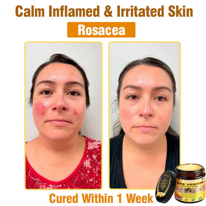 𝐋𝐎𝐕𝐈𝐋𝐃𝐒™ 𝐁𝐞𝐞 𝐕𝐞𝐧𝐨𝐦 𝐀𝐥𝐥-𝐢𝐧-𝐎𝐧𝐞 𝐂𝐫𝐞𝐚𝐦–🌸 Anti-aging,Hydrating, Skin Repair, Even Tone, Acne and Dark Spot Treatment, Wart and Mole Removal, Psoriasis Relief