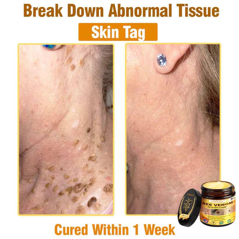 𝐋𝐎𝐕𝐈𝐋𝐃𝐒™ 𝐁𝐞𝐞 𝐕𝐞𝐧𝐨𝐦 𝐀𝐥𝐥-𝐢𝐧-𝐎𝐧𝐞 𝐂𝐫𝐞𝐚𝐦–🌸 Anti-aging,Hydrating, Skin Repair, Even Tone, Acne and Dark Spot Treatment, Wart and Mole Removal, Psoriasis Relief